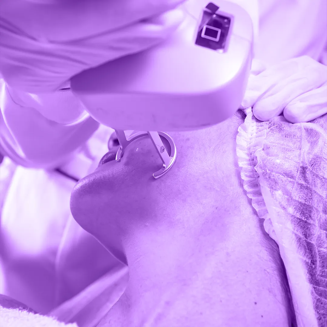 Cliente fazendo remoção de manchas e pigmentos no rosto com laser facial